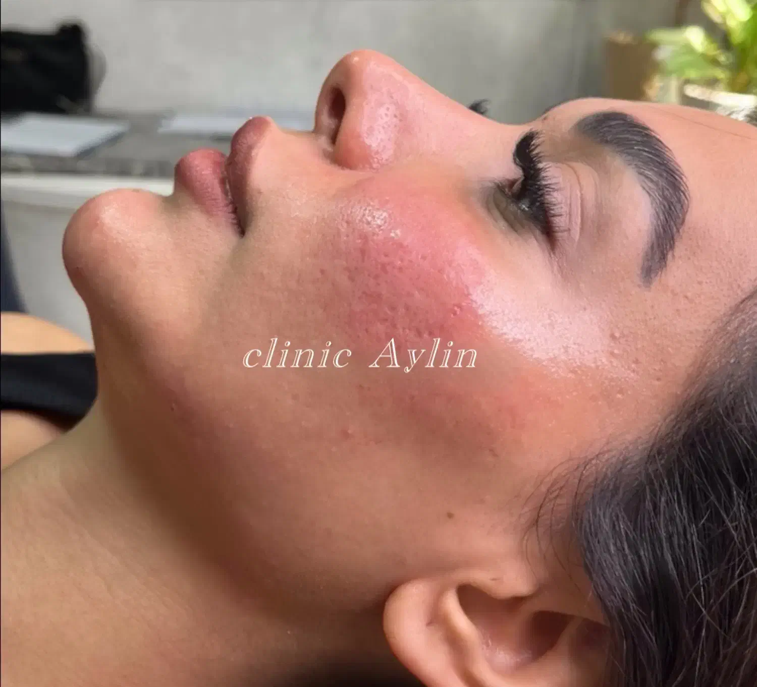 ژل لب فیلر بوتاکس مزو جوانسازی کانتوریگ لیفت نخ|خدمات آرایشگری و زیبایی|تهران, پونک|دیوار