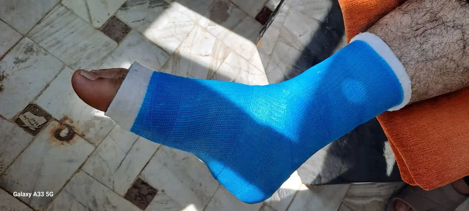 گچ گرفتن و آتل گرفتن توسط کارشناس اتاق عمل|خدمات آرایشگری و زیبایی|قم, پردیسان|دیوار