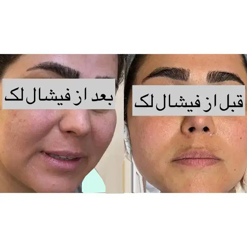 فیشیال ویژه بانوان عزیز و آقایون|خدمات آرایشگری و زیبایی|کرمانشاه, |دیوار