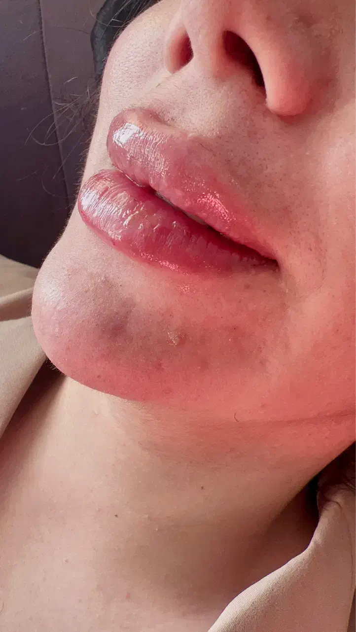 ژل بوتاکس ژل لب فیلرزیر چشم مزوتراپی مزوژل|خدمات آرایشگری و زیبایی|شیراز, کاراندیش|دیوار