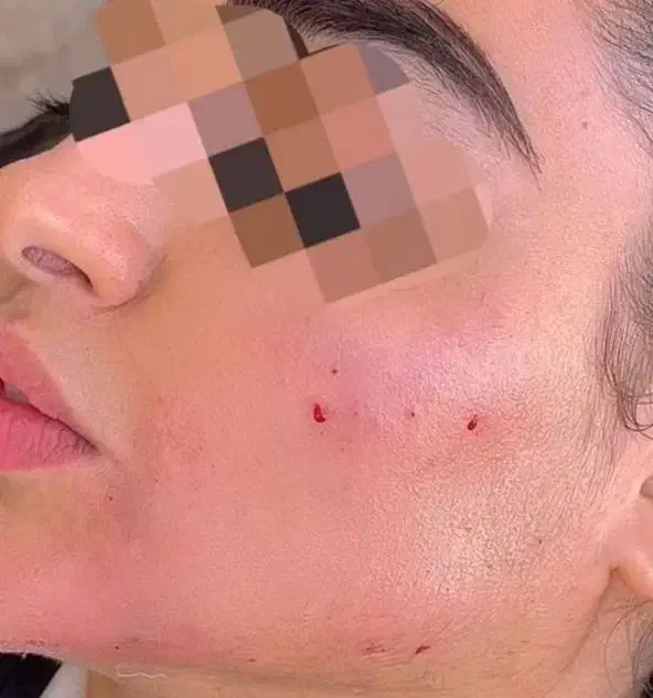 تزریق ژل وفیلر|خدمات آرایشگری و زیبایی|رباطکریم, رباطکریم|دیوار