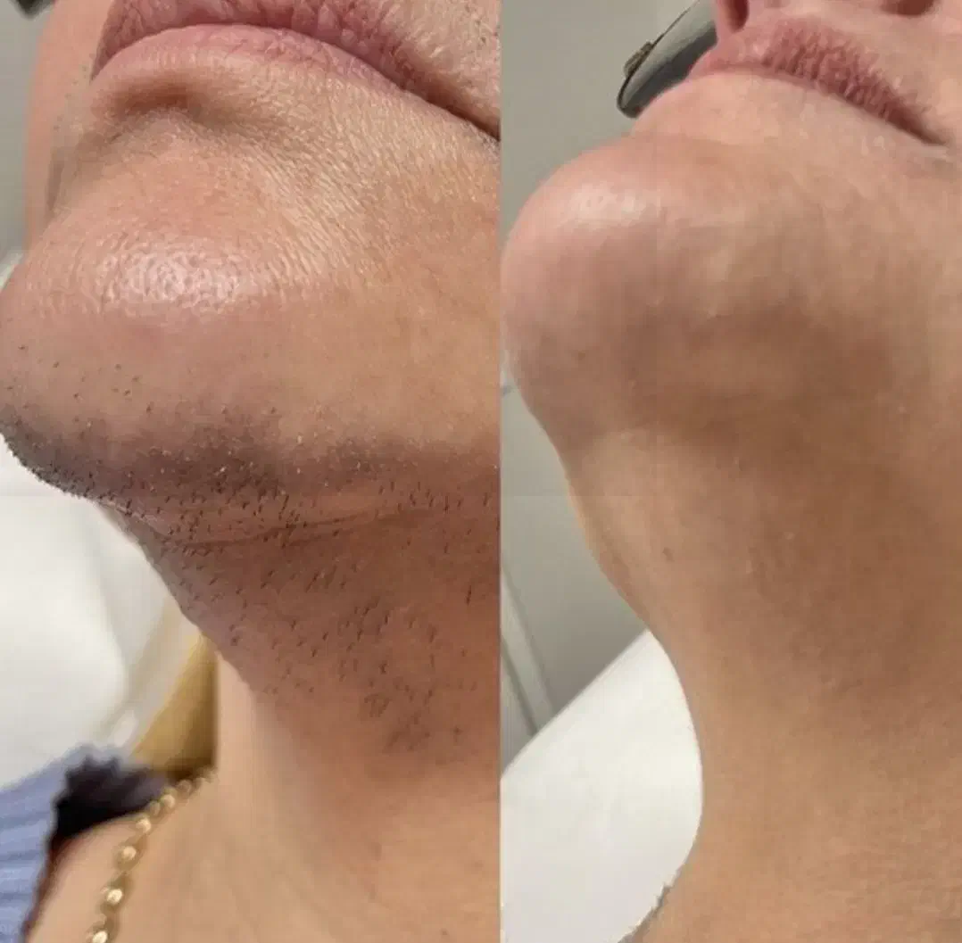 جشنواره زمستانه لیزرموهای زائد ریزش تضمینی در مطب|خدمات آرایشگری و زیبایی|زنجان, |دیوار