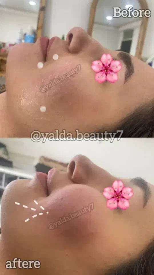 تزریق ژل و بوتاکس|خدمات آرایشگری و زیبایی|بابل, |دیوار