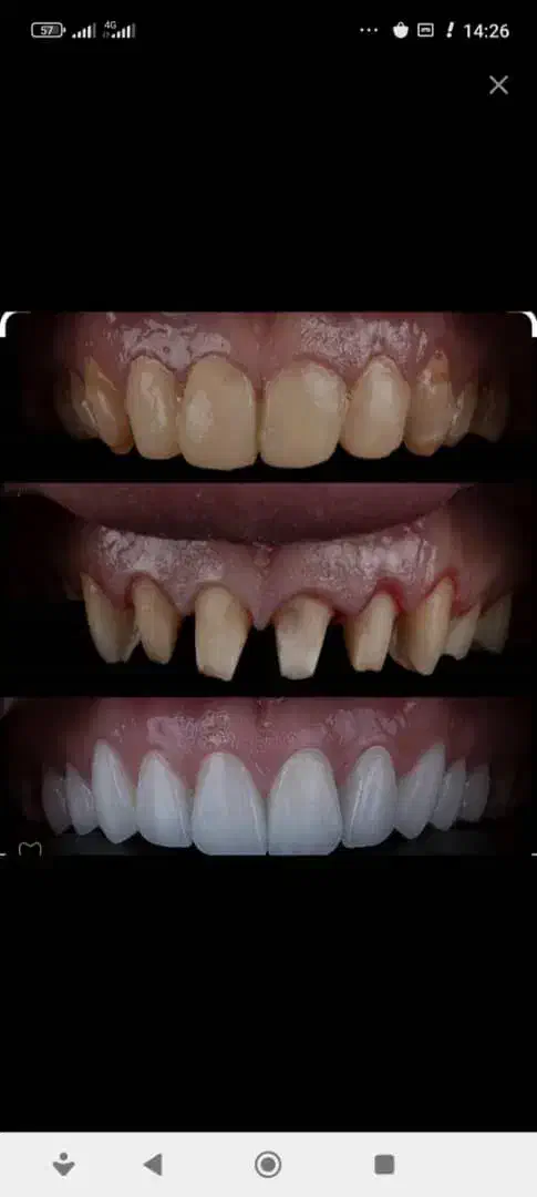 روکش دندان ، کامپوزیت|خدمات آرایشگری و زیبایی|تهران, تهرانسر غربی|دیوار