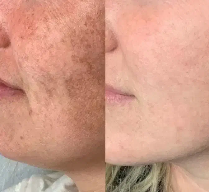 کرم روشن وضدلک قوی|آرایشی، بهداشتی، درمانی|کرمان, |دیوار