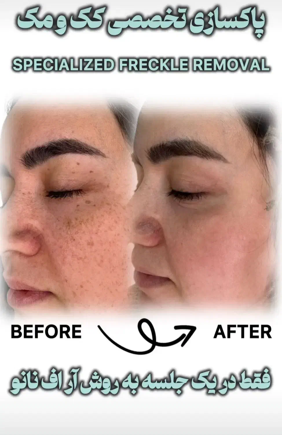 مرکز تخصصی حذف لک وکک ومک|خدمات آرایشگری و زیبایی|اهواز, پادادشهر|دیوار