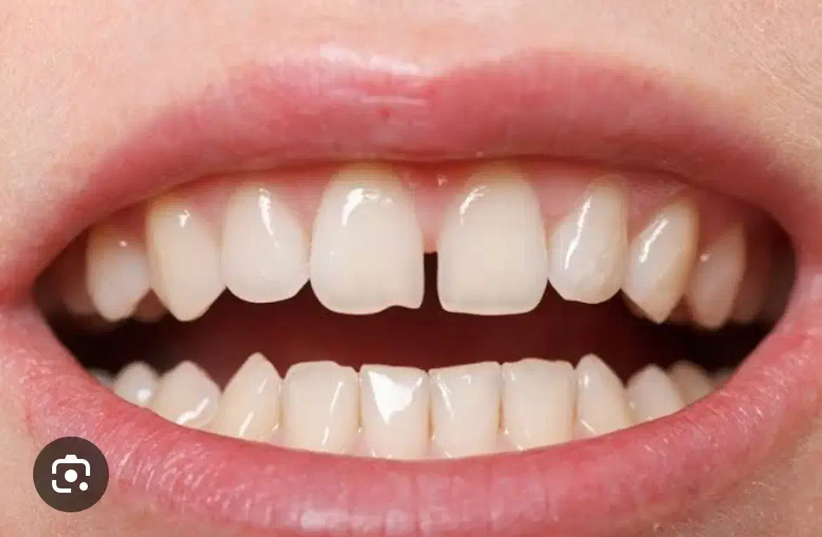 کشیدن دندان های کرسی توسط دانشجو|خدمات آرایشگری و زیبایی|بیرجند, |دیوار