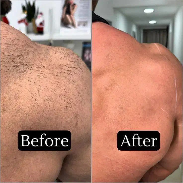 لیزر|خدمات آرایشگری و زیبایی|تهران, تهرانپارس شرقی|دیوار