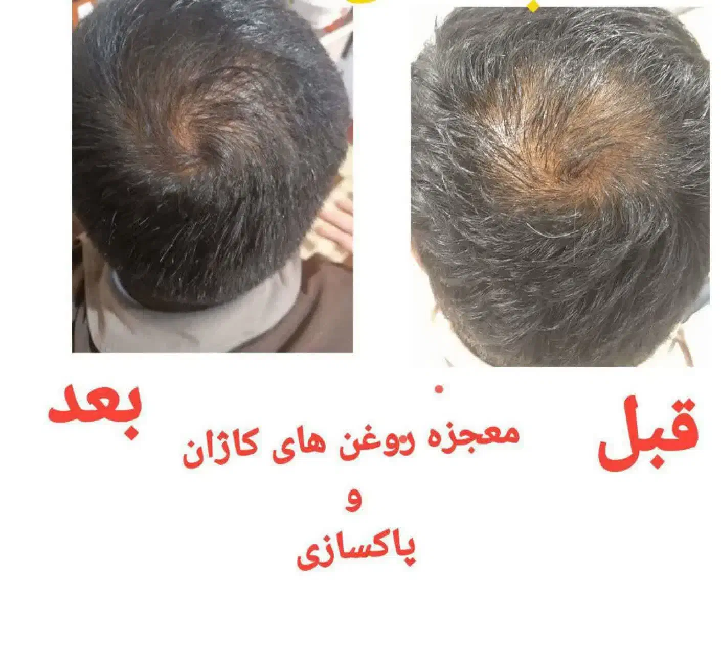 تقویت و رویش مجدد مو|آرایشی، بهداشتی، درمانی|قائن, |دیوار