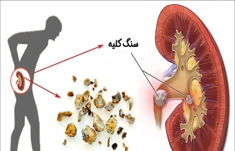 سنگ کلیه|خوردنی و آشامیدنی|مهاباد (آذربایجان غربی), |دیوار