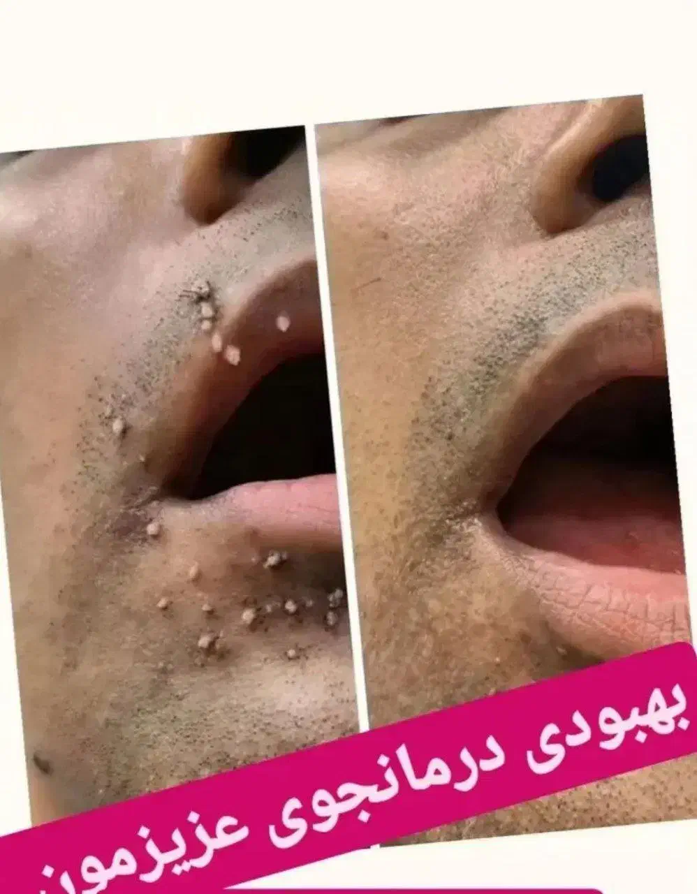 بهبود زگیل تناسلی|آرایشی، بهداشتی، درمانی|کلاله, |دیوار