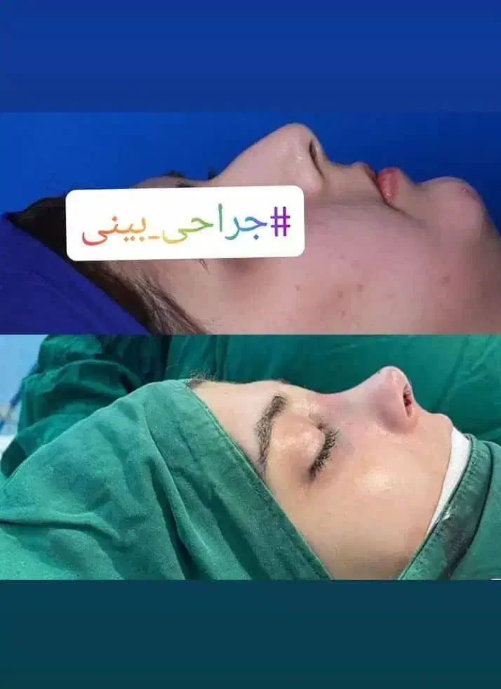 جراحی بینی|خدمات آرایشگری و زیبایی|کرج, عظیمیه|دیوار