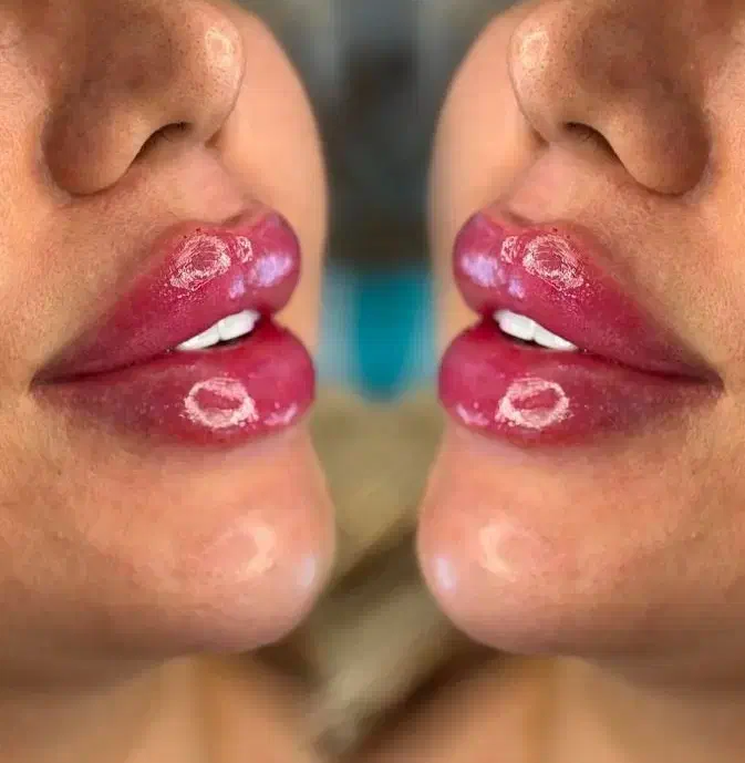 به یک مُدل خانم برای تزریق ژل لب نیازمندیم،رایگان|خدمات آرایشگری و زیبایی|اسلامشهر, شهرک مهدیه|دیوار