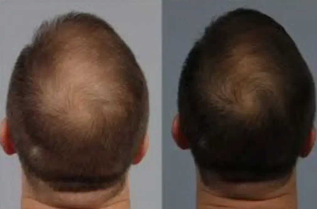 خدمات پی آر پی(PRP)پوست و مو و مزوتراپی اگزوزوم|خدمات آرایشگری و زیبایی|اصفهان, دشتستان|دیوار