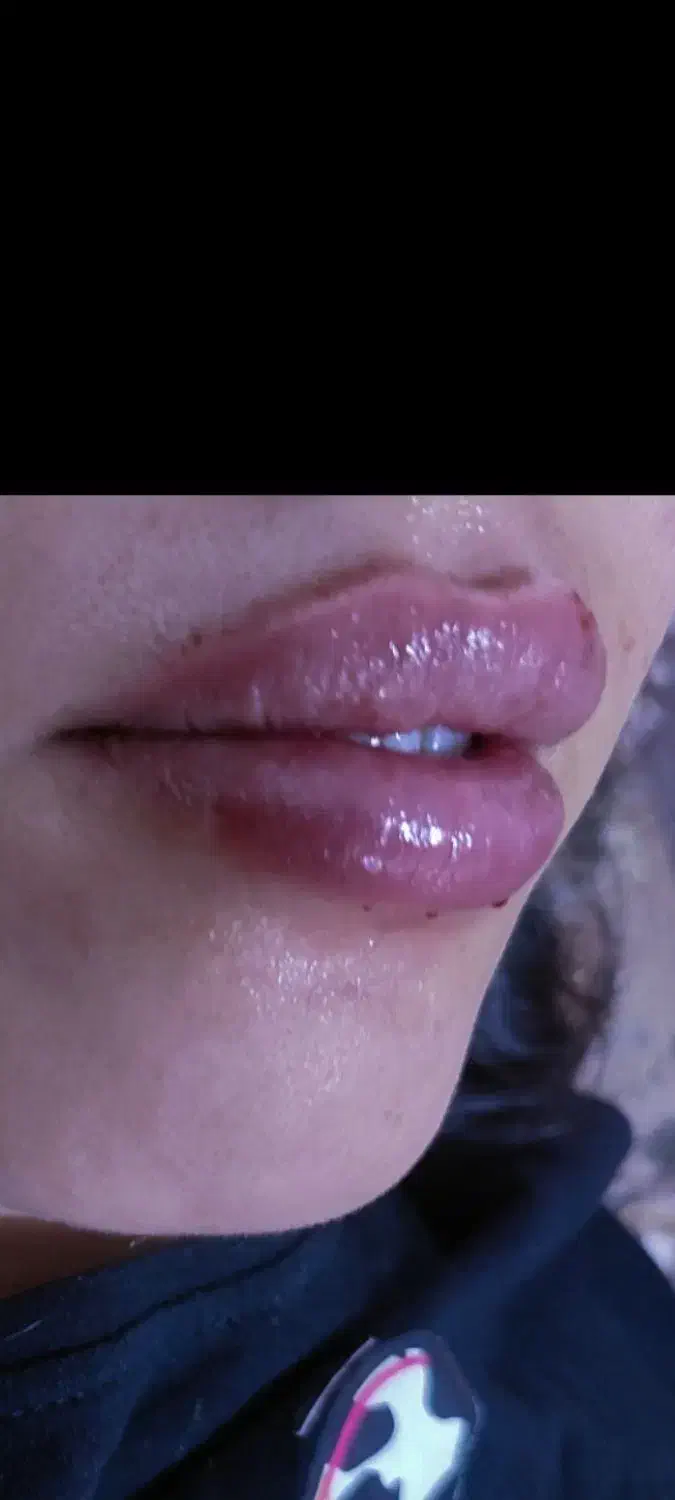 آنزم و مزو تراپی و فیلر و بوتاکس|خدمات آرایشگری و زیبایی|قرچک, مهدیه|دیوار