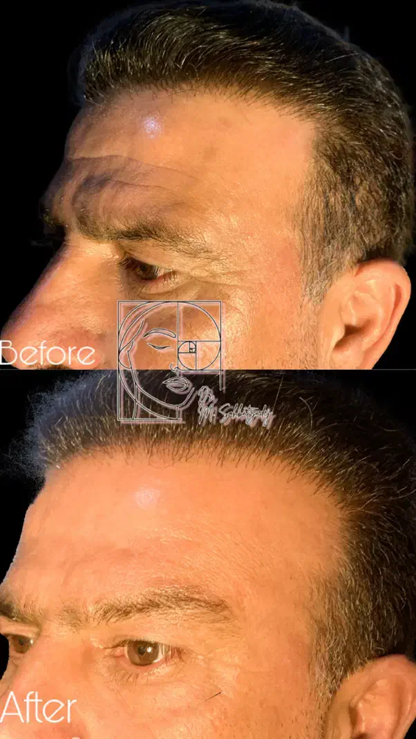 بوتاکس و فیلر صورت برای مدل تحت نظر پزشک|خدمات آرایشگری و زیبایی|زنجان, |دیوار