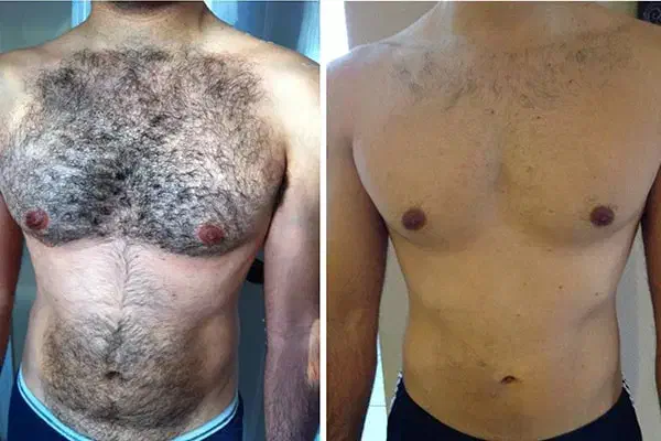 لیزر موهای زائد مخصوص آقایون ،در مطب شاین|خدمات آرایشگری و زیبایی|بم, |دیوار