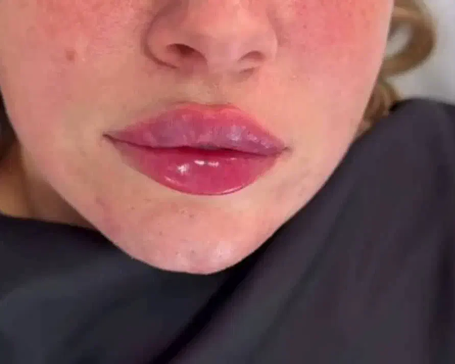 تزریقات ژل و بوتاکس و آنزیم|خدمات آرایشگری و زیبایی|اسلام‌شهر, شهرک مهدیه|دیوار