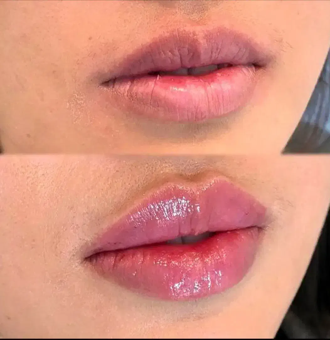 جشنواره  یلدایی تزریق ژل فقط و فقط هر سیسی ۱ ملیون|خدمات آرایشگری و زیبایی|همدان, |دیوار