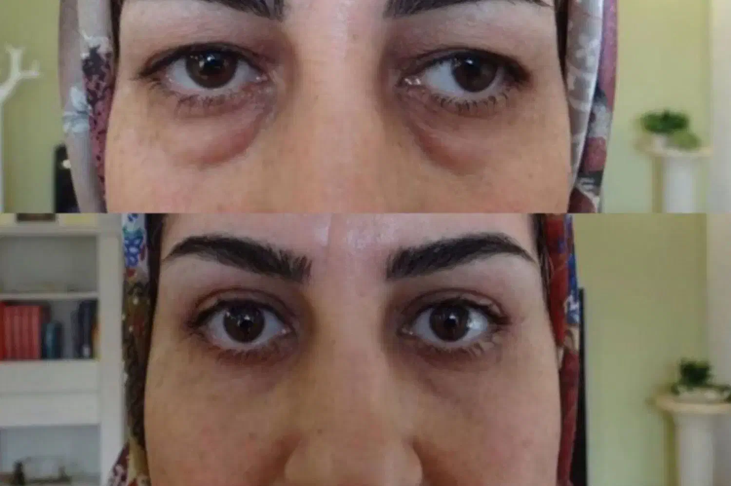 دیگه نیاز به عمل و جراحی نیست|آرایشی، بهداشتی، درمانی|نیشابور, جمهوری|دیوار