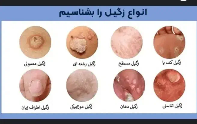 پماد رفع زگیل تناسلی انواع خال و میخچه|آرایشی، بهداشتی، درمانی|یاسوج, |دیوار