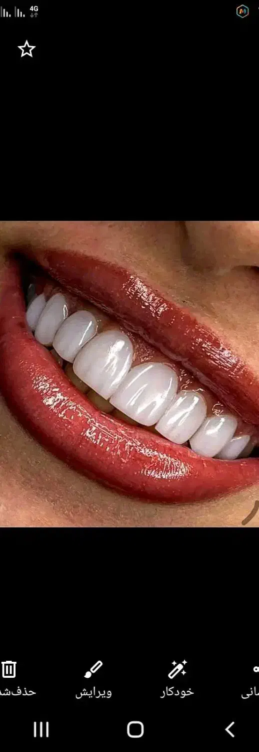 جشنواره کامپوزیت ونیر لمینیت روکش عصب ترمیم IMAX|خدمات آرایشگری و زیبایی|تهران, پاسداران|دیوار