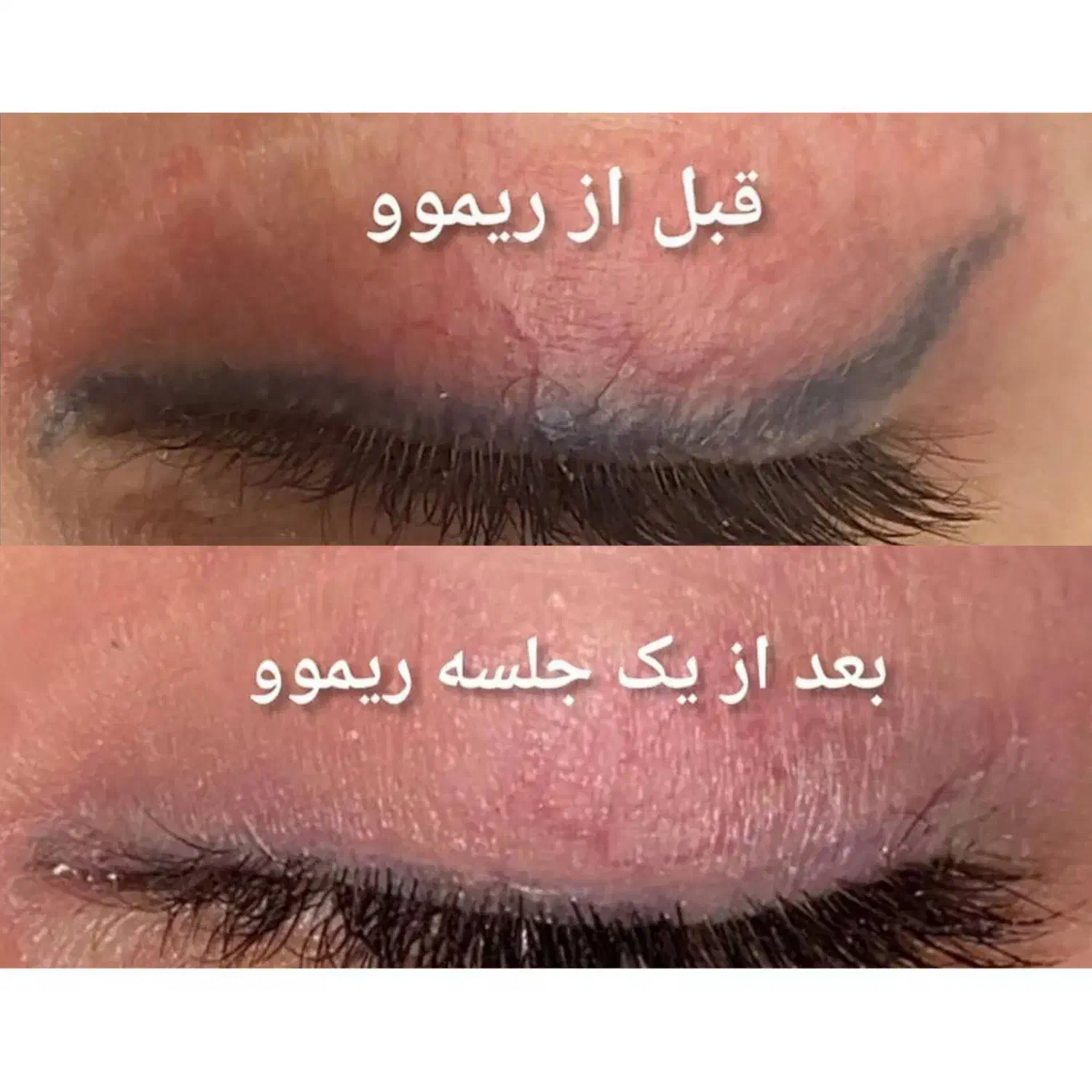 ریموو(پاک کردن تاتو) صورت وبدن با لیزر پیشرفته|خدمات آرایشگری و زیبایی|تبریز, |دیوار