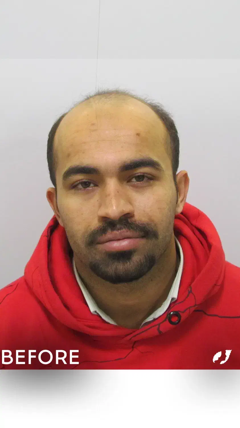 کاشت مو و ابرو|خدمات آرایشگری و زیبایی|تهران, جردن|دیوار