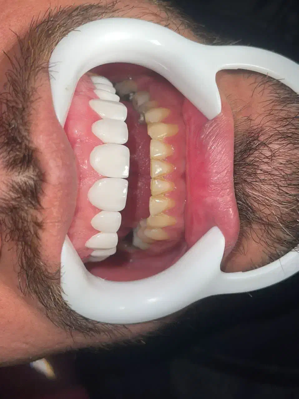 کامپوزیت/لمینیت/ایمپلنت/عصب کشی،و درمانی اقساطی|خدمات آرایشگری و زیبایی|مشهد, جنت|دیوار