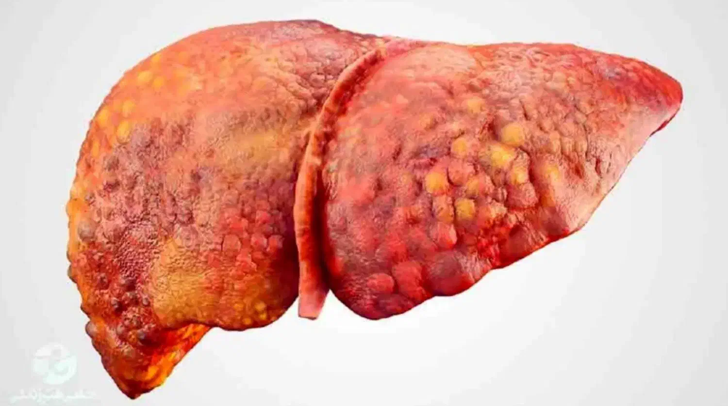 بهبودکبد چرب|آرایشی، بهداشتی، درمانی|ساوه, |دیوار