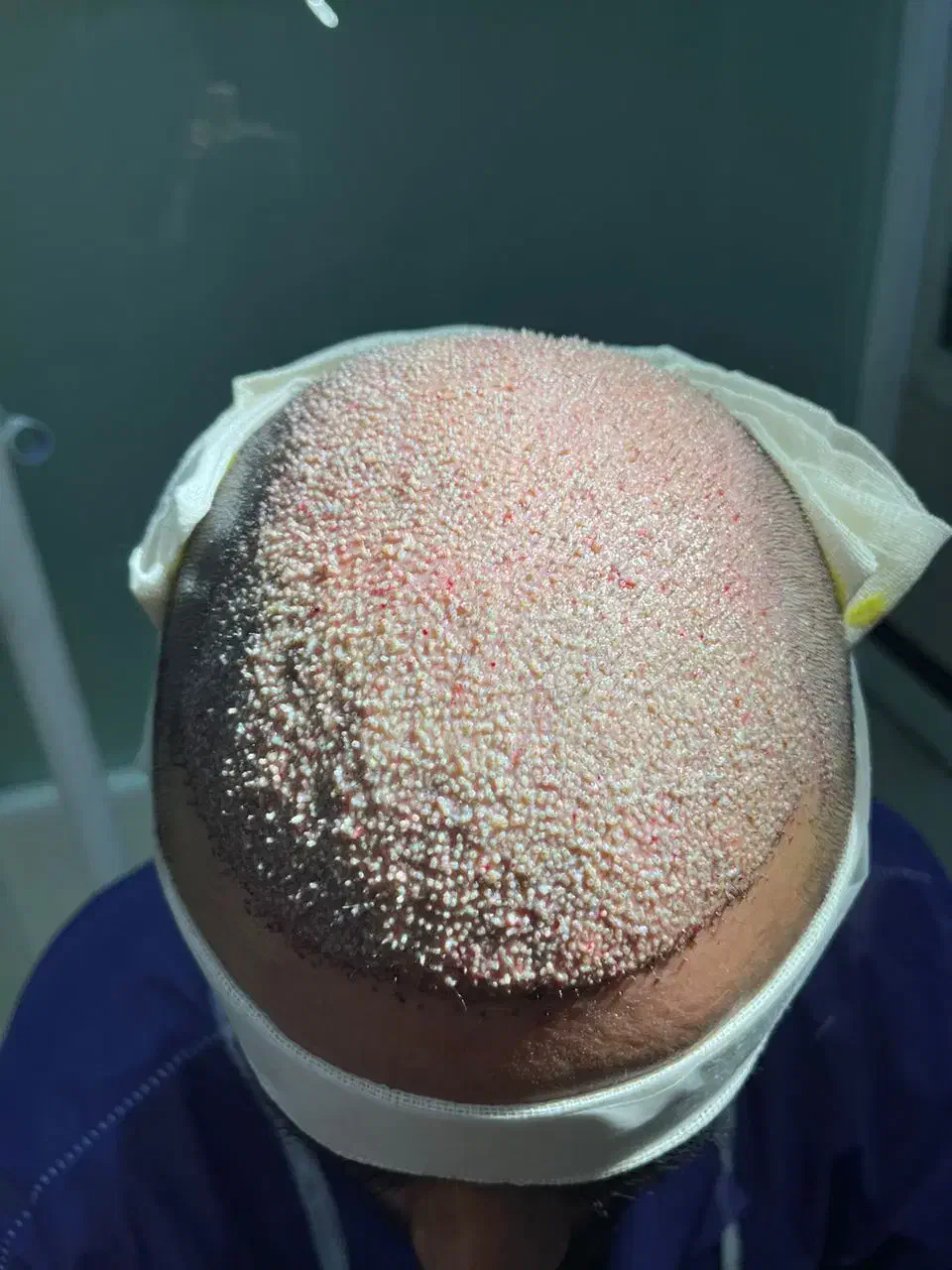 جشنواره پاییزی کاشت مو|خدمات آرایشگری و زیبایی|شاهین دژ, |دیوار