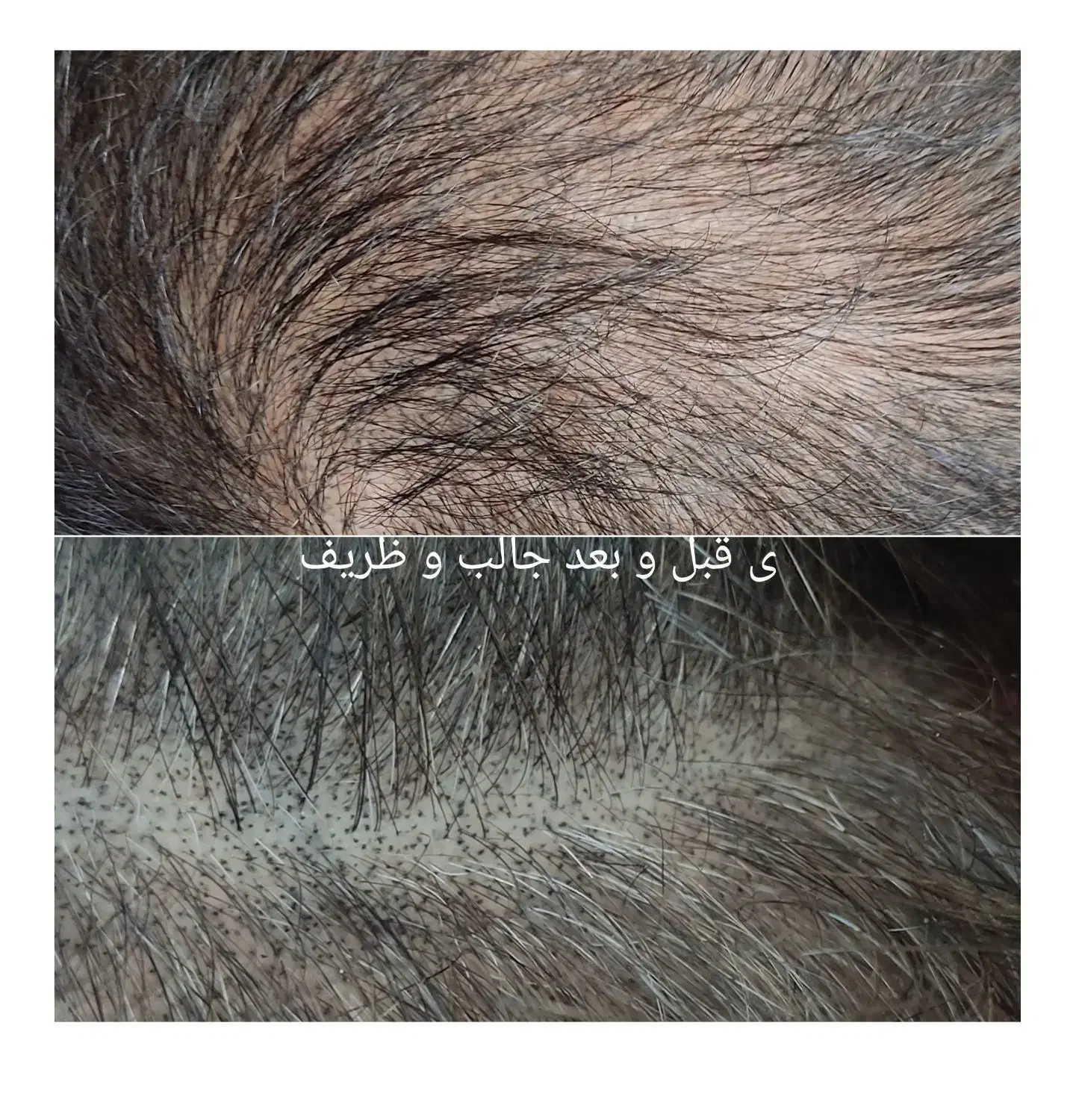 با تکنیک میکرواسکالپ،کم پشتی مو دیگه دیده نمیشه|خدمات آرایشگری و زیبایی|شاهین‌شهر, فردوسی|دیوار