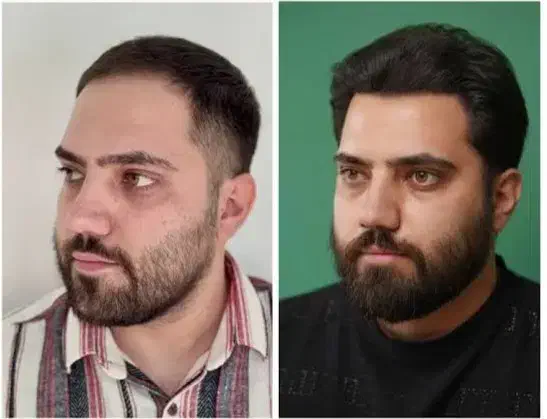 جشنواره یلدایی کاشت مو پرتراکم فقط با ۸ پیش|خدمات آرایشگری و زیبایی|تهران, محمودیه|دیوار