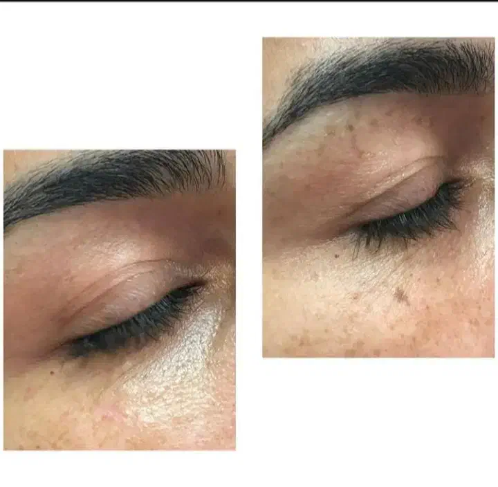 خال برداری ،میخچه زگیل وتمامی زائده هاباقطره گیاهی|خدمات آرایشگری و زیبایی|اصفهان, شفق|دیوار