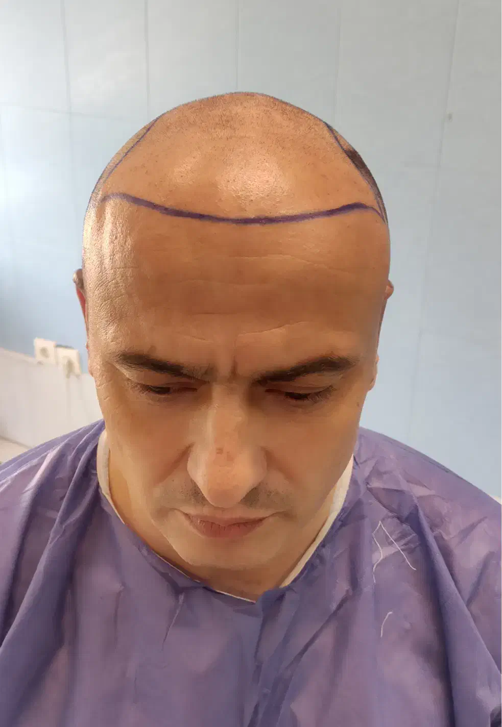 کاشت مو و مزوتراپی اقساط|خدمات آرایشگری و زیبایی|مشهد, احمدآباد|دیوار