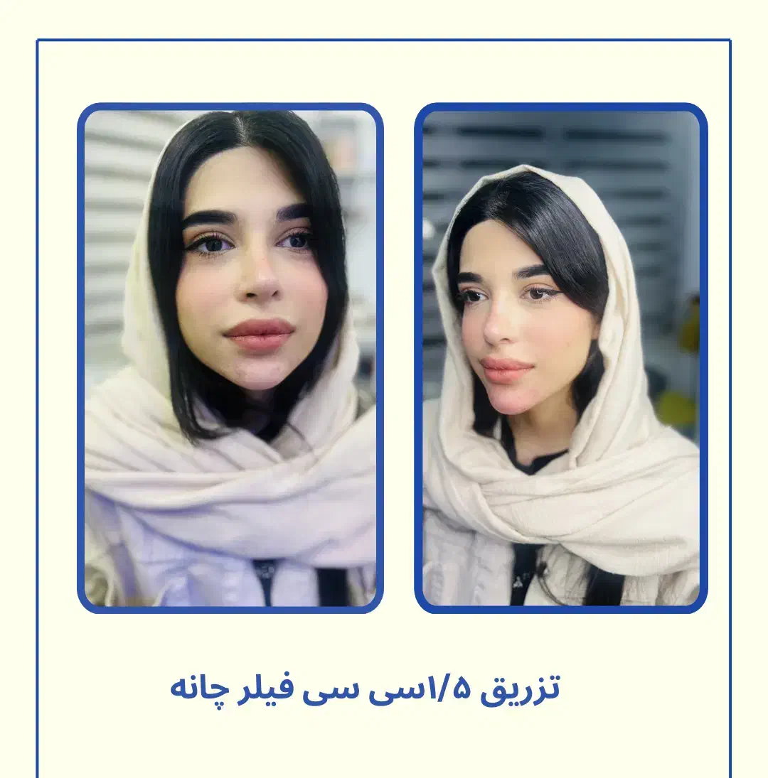 فیلر لب روسی -زاویه سازی -بوتاکس-پی ار پی -مزو|خدمات آرایشگری و زیبایی|تهران, دریا|دیوار