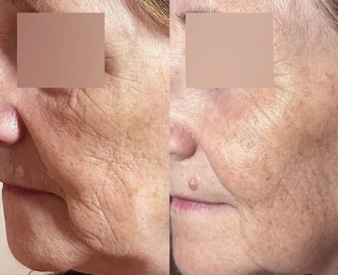 تزریق جوانسازها و ژل لب و گونه|خدمات آرایشگری و زیبایی|ورامین, ورامین|دیوار