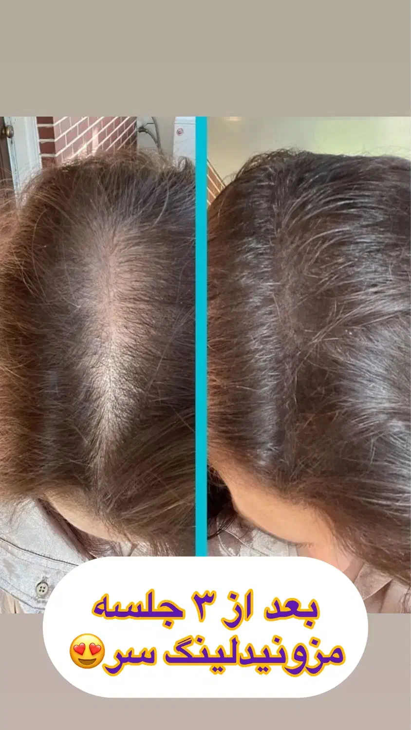 فیشال و مزونیدلینگ پوست و لیفت مژه ابرو و کاشت مژه|خدمات آرایشگری و زیبایی|تهران, تهرانپارس غربی|دیوار