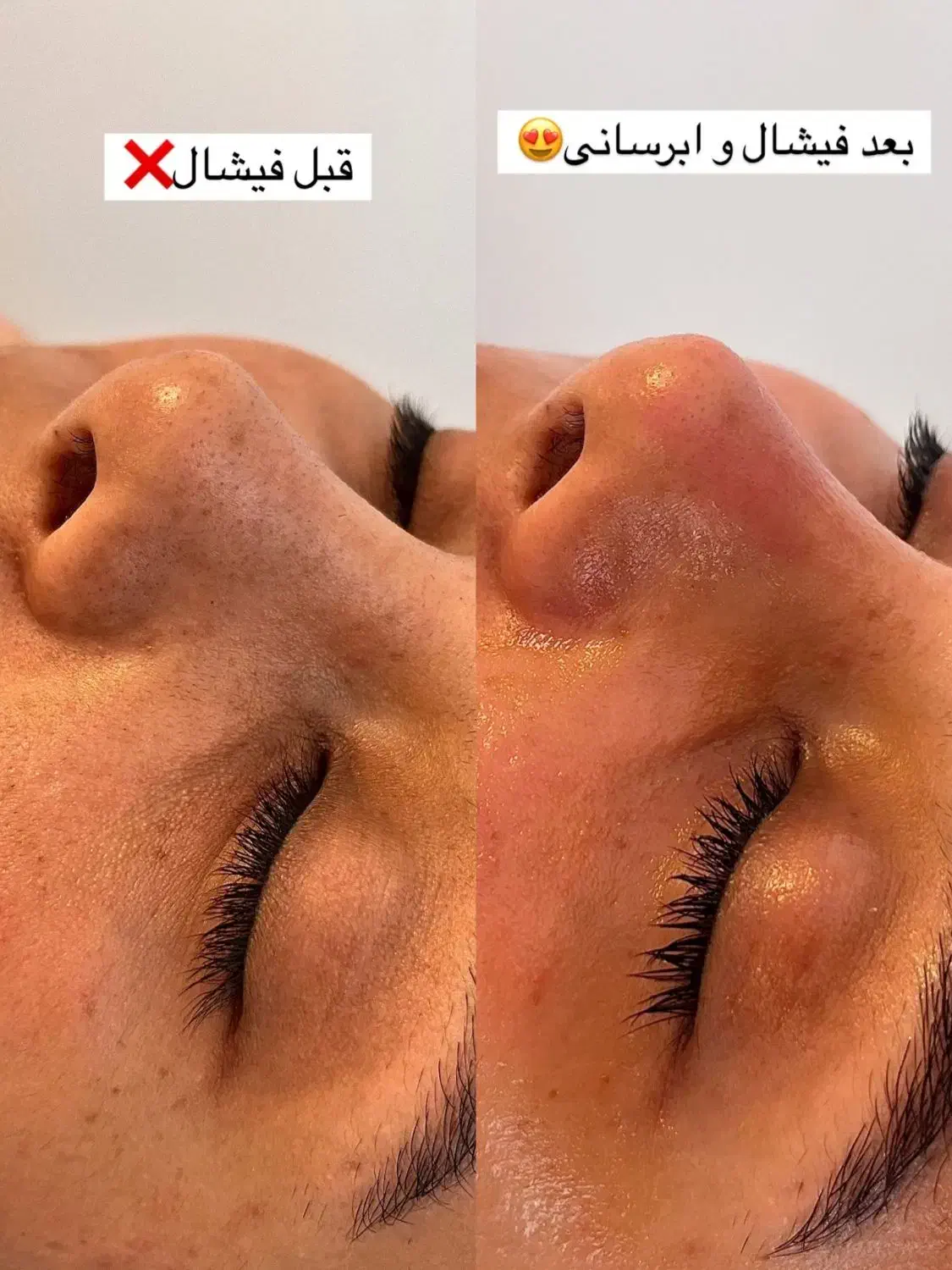 پاکسازی تخصصی پوست و لیفت ابرو روسی|خدمات آرایشگری و زیبایی|تنکابن, |دیوار