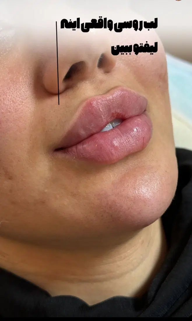 تزریق ژل بوتاکس فیلر لیزر فشیال مزو درمطب|خدمات زیبایی و سلامت|تبریز, |دیوار