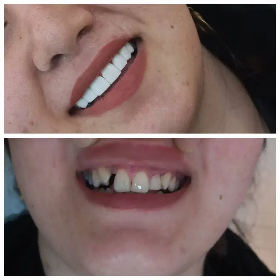 کامپوزیت زیبایی دندان درکلینیک دندانپزشکی|خدمات آرایشگری و زیبایی|یاسوج, |دیوار