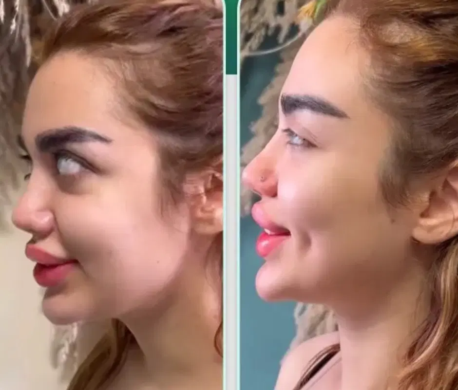 خدمات وآموزش چال لپ پرسینگ میکرودرمال نگین دندان|خدمات زیبایی و سلامت|اصفهان, شاهد|دیوار