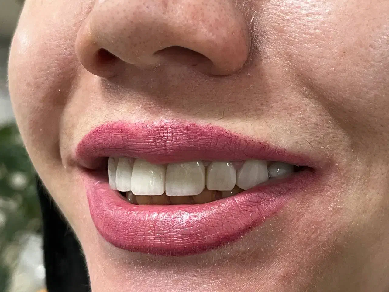 تخفیفات وشرایط اقساطی برای ایمپلنت و پروتز مصنوعی|خدمات آرایشگری و زیبایی|بجنورد, |دیوار