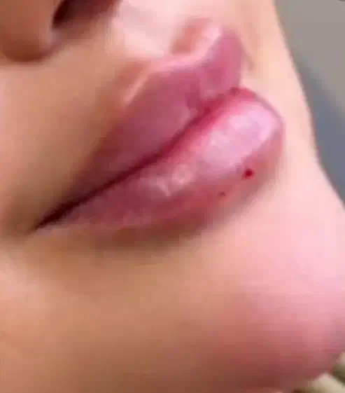 مدل ژل لب گونه چونه بوتاکس|خدمات آرایشگری و زیبایی|اسلام‌شهر, مطهری|دیوار