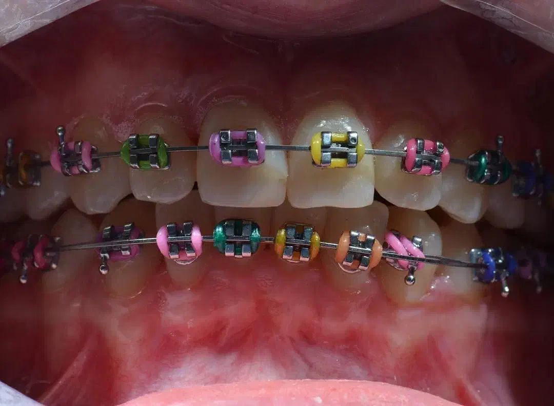 ارتودنسی ثابت و متحرک با اقساط بلند مدت|خدمات آرایشگری و زیبایی|میانه, |دیوار