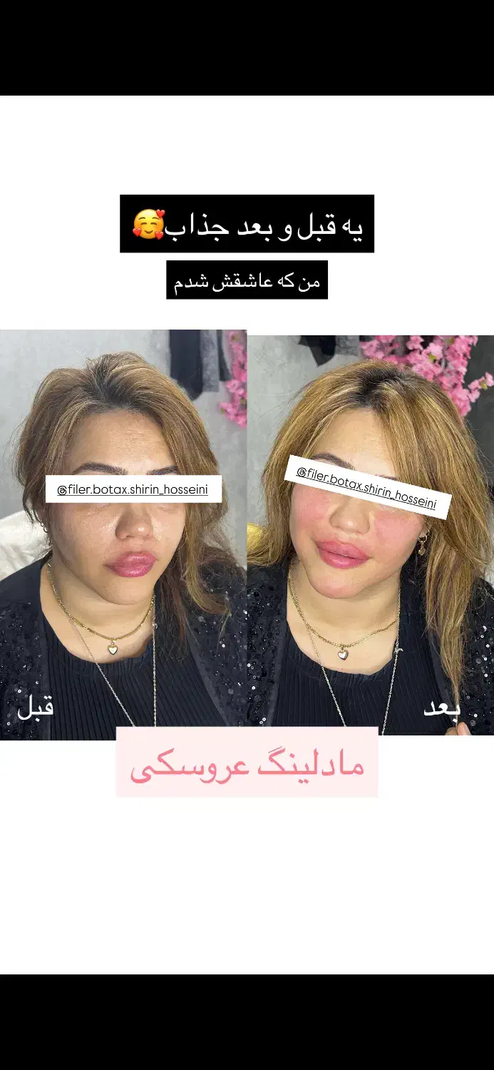 ژل، بوتاکس،آنزیم،مزوتراپی پی ار پی،فیلر بادی|خدمات آرایشگری و زیبایی|اهواز, گلستان|دیوار