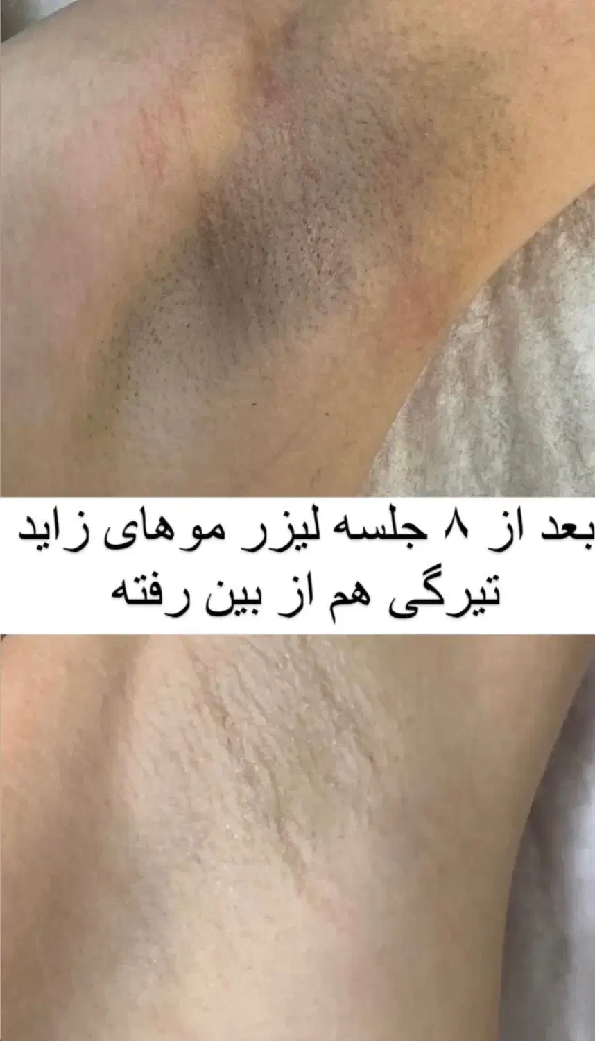 لیزر فقط ‌فقط 690تومان|خدمات آرایشگری و زیبایی|گنبد کاووس, |دیوار