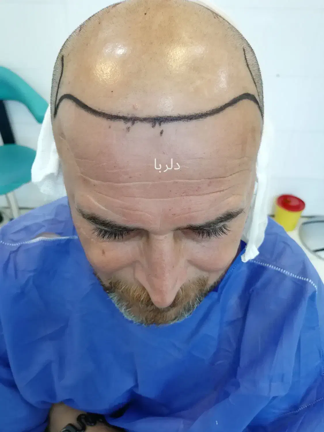 کاشت مو تخصصی دلربا|خدمات آرایشگری و زیبایی|حمیدیه, |دیوار