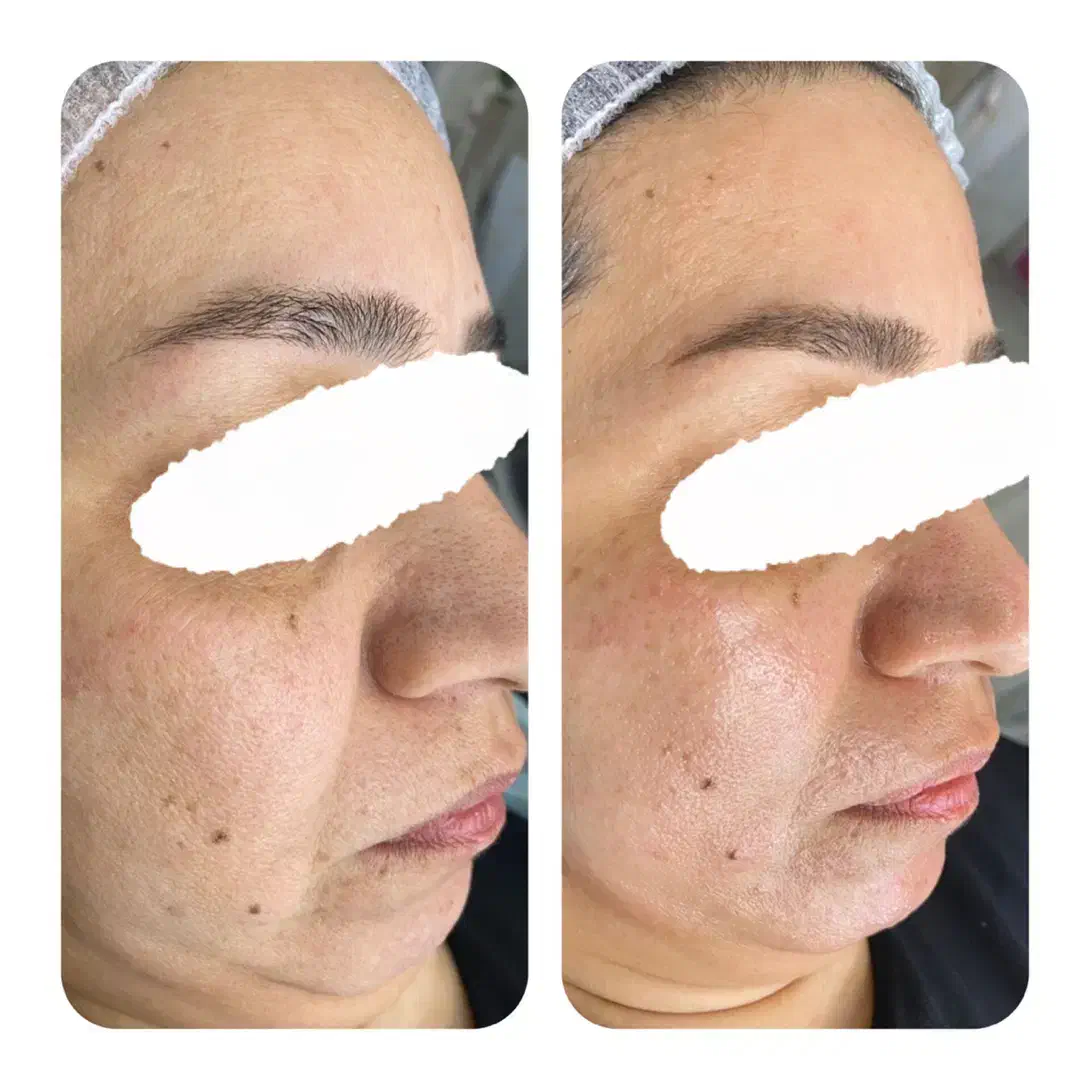 پاکسازی و فیشال پوست|خدمات آرایشگری و زیبایی|مشهد, امام رضا (ع)|دیوار