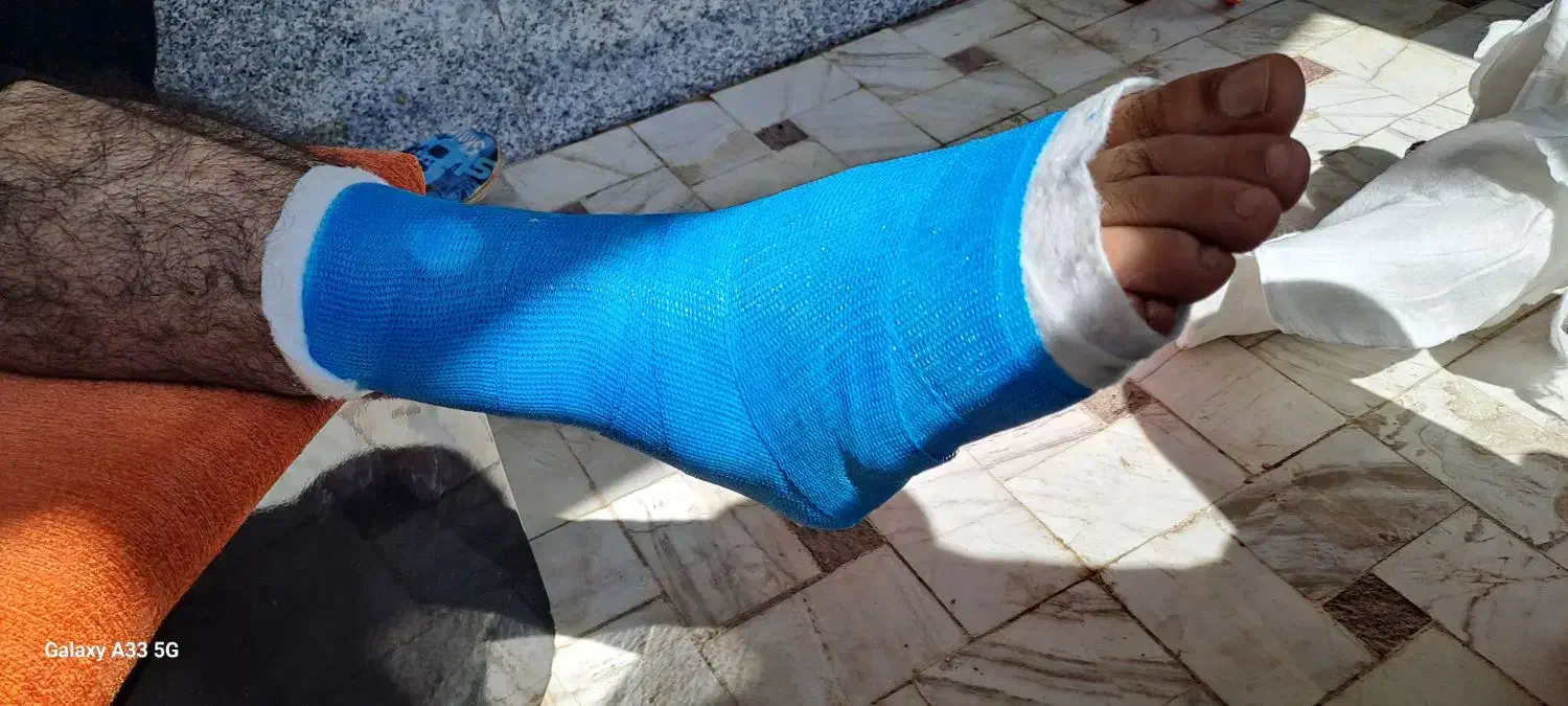 گچ گرفتن و آتل گرفتن توسط کارشناس اتاق عمل|خدمات آرایشگری و زیبایی|قم, پردیسان|دیوار